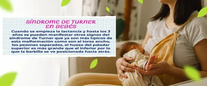 Síndrome de Turner en bebes