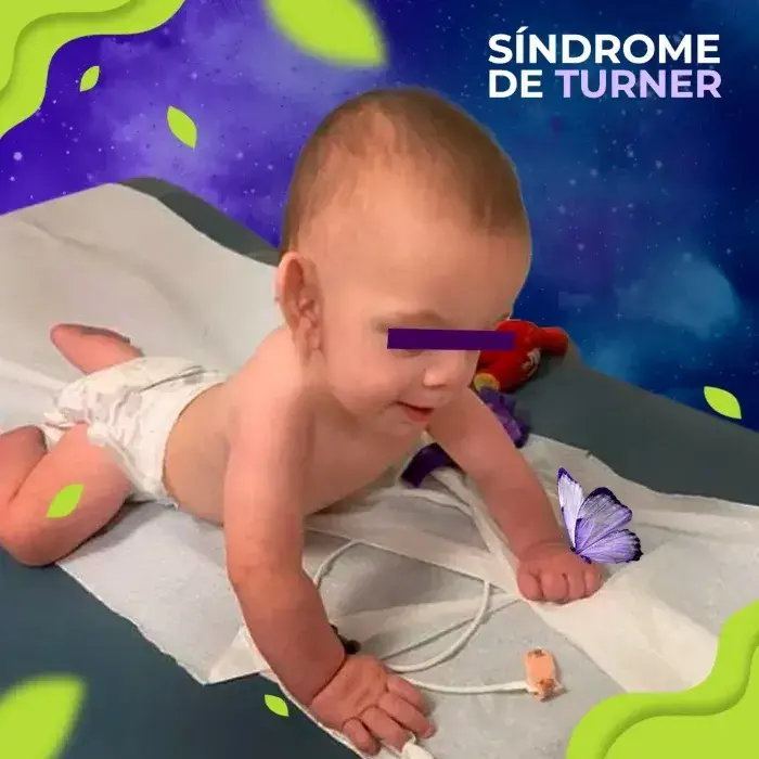Bebé que sufre de síndrome de Turner