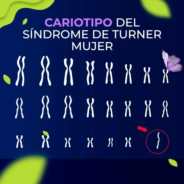 El cariotipo del síndrome de Turner