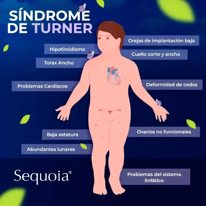Las características del síndrome de Turner (hipotiroidismo, tórax ancho, abundantes lunares ovario nos funcionales, problemas linfáticos, talla baja, orejas bajas, problemas cardiacos, cuello corto).